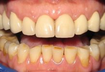 10 moduri de a elimina placa dentara in mod natural