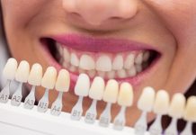 TOT ce trebuie să știi despre fațetele dentare