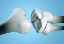 Ce trebuie sa stie femeile cu artrita despre osteoporoza